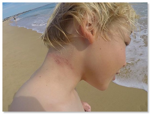 Wetsuit rash